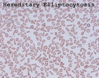 Hereditary elliptocytosis (HE)