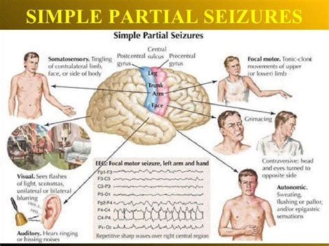 Epilepsy.ppt