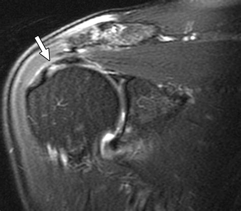 Torn rotator cuff mri image