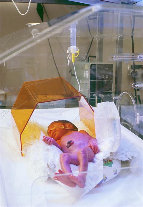 Neonatal Jaundice Treatment Photograph by Eddie Lawrence/science Photo Library - Pixels