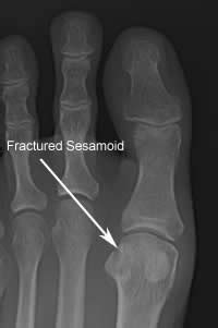 bunion, hammer toe, nail fungus, hallux rigidus