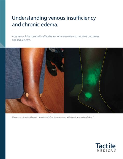 Venous Insufficiency and Chronic Edema Brochure - Tactile Medical