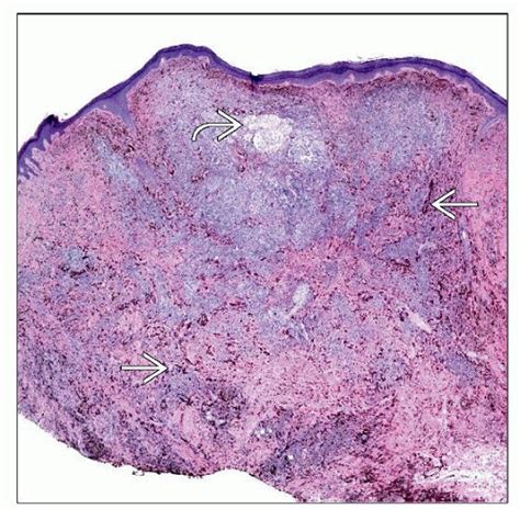 Malignant Cellular Blue Nevus (Melanoma Arising in Cellular Blue Nevus) | Basicmedical Key