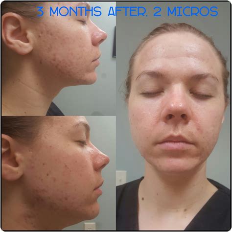 PCOS Acne Update