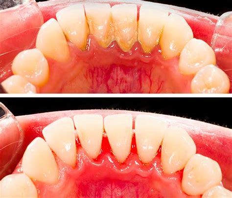 Periodontal Scaling And Root Planing Before And After - slide share