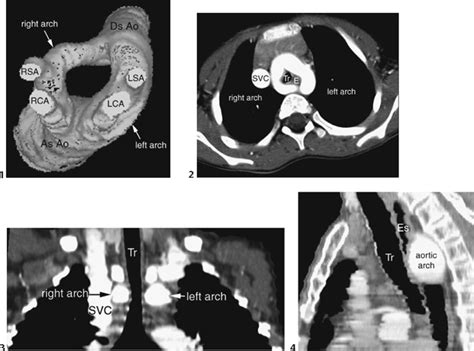 54 Double Aortic Arch | Radiology Key