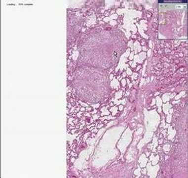 Histopathology Lung --Tuberculosis - YouTube