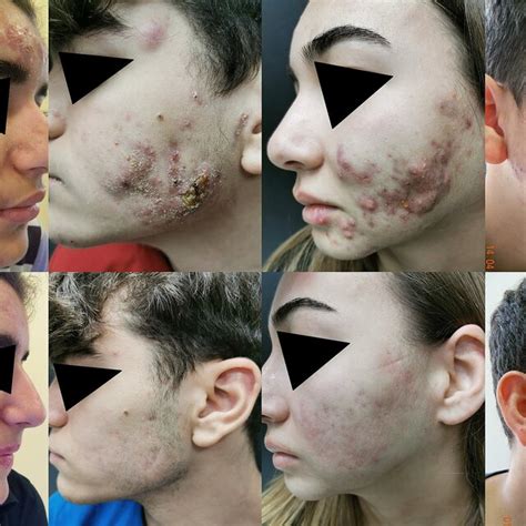 Clinical appearance of acne fulminans in four patients before and after ...