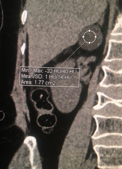 Adrenal adenoma | Radiology imaging, Radiology, X ray