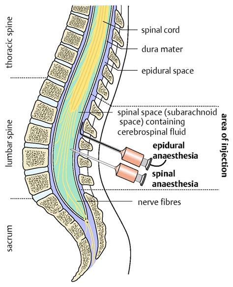 Obstetric Regional Anaesthesia | Epidural, Spinal, Anesthesia