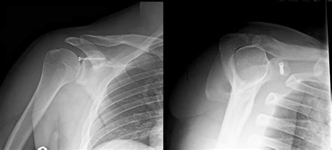 Case Presentation for Arthroscopic Internal Fixation of Coracoid Fracture | Published in Journal ...