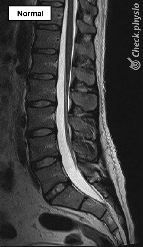 Lumbar spinal stenosis | Physio Check