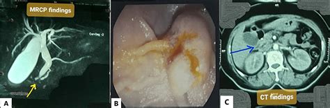 Cureus | Neuroendocrine Tumor of the Ampulla of Vater: A Case Report