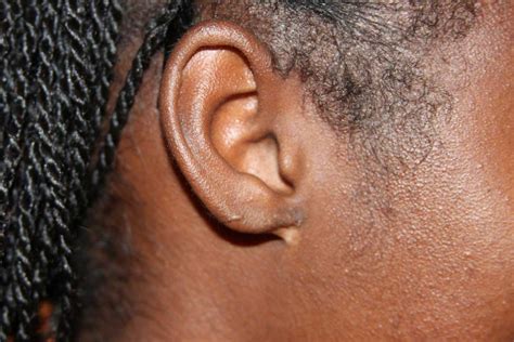 Poor surgical Outcome - Keloid Removal Expert - New York