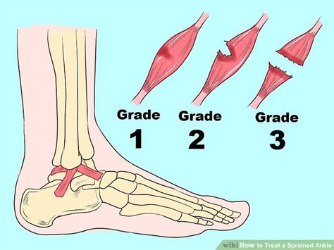 4 Ways to Treat a Sprained Ankle - wikiHow