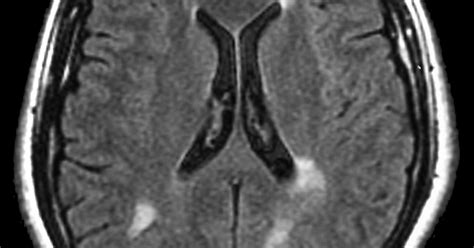 MS Lesions | Symptoms and Diagnosis | Multiple Sclerosis News Today