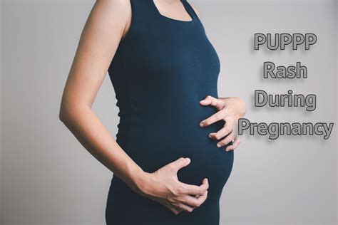 PUPPP Rash During Pregnancy: Causes, Symptoms And Treatment - Being The Parent