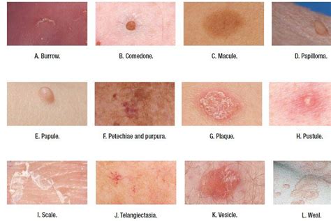 Pin by Maria on RN | Dermatology nurse, Skin ulcer, Medical