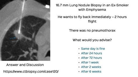 Case 120: Right Upper Lobe Lung Nodule Biopsy - Patient Wants to Fly Back Immediately