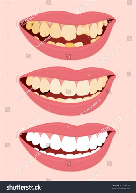 Progressive Stages Of Tooth Decay, Illustration Of Open Female Mouth Showing Three Steps To ...