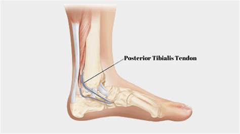 Posterior Tibial Tendonitis Foot Pain Explored