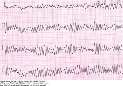 Torsades de pointes. Funny name. Serious trouble. | Ecg interpretation ...