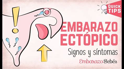 EMBARAZO #ECTÓPICO 💔😭 Signos y síntomas - YouTube