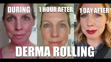 DERMA ROLLING STEP BY STEP | DO'S & DON'TS! - YouTube