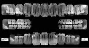 Dental X-Rays | Dr. Ross| Loveland, Colorado