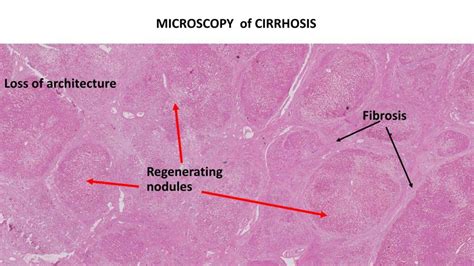 Liver Cirrhosis Histology