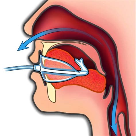 © ApniCure, Inc. The oral pressure therapy system consists of a bedside ...