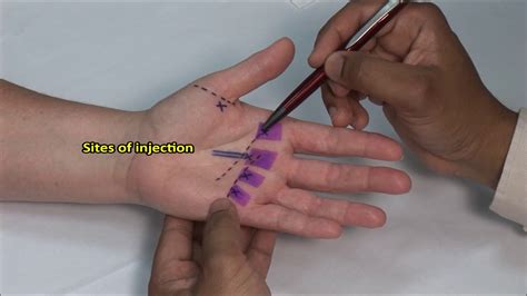 Flexor Tendonitis (Hand) Injection - YouTube