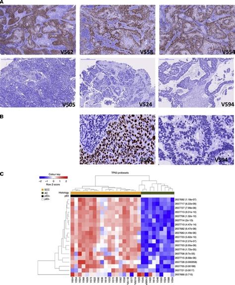 Concordance of TP63 probeset with p63 protein immunohistochemistry. (A ...