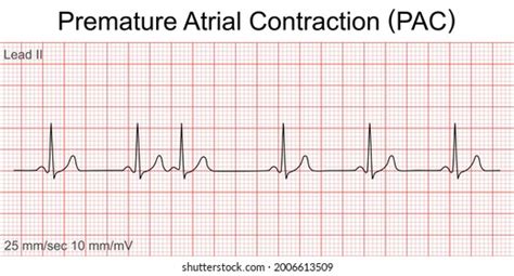 Abnormal Heart Rate: Over 156 Royalty-Free Licensable Stock Vectors & Vector Art | Shutterstock