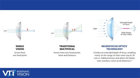 Understanding the NaturalVue multifocal contact lens - Myopia Profile