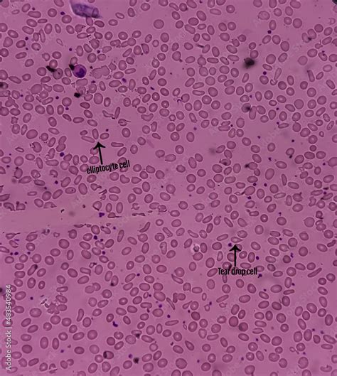 Hereditary elliptocytosis, hereditary disorder of RBCs, Ovalocytes or elliptocytes are oval or ...