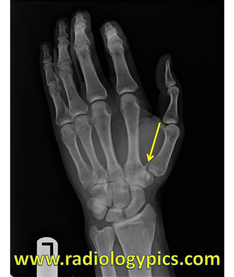 Solution to Unknown Case #25 – Bennett Fracture | RADIOLOGYPICS.COM