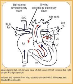 Glenn procedure Ultrasound, Tid, Oxygen, Brain