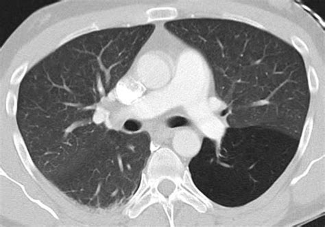 Bronchial atresia - Bronchial atresia with prominent air trapping in ...