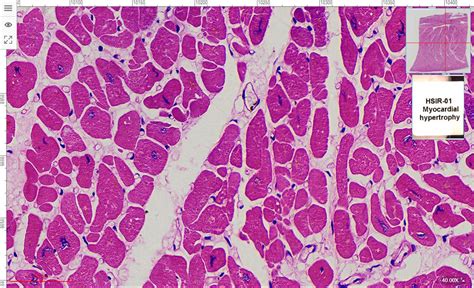 Myocardial hypertrophy section, 7um, H.E. Stain, University Standard ...