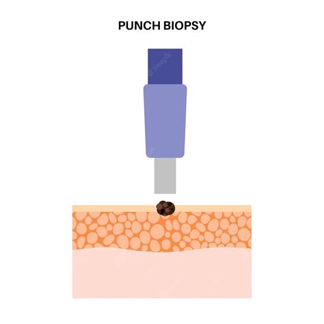 Premium Vector | Punch biopsy procedure