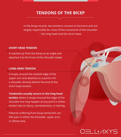 Shoulder Tendonitis Treatment