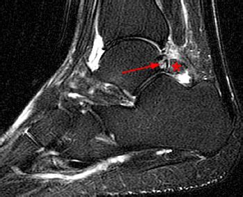 Posterior Ankle Impingement | Radsource