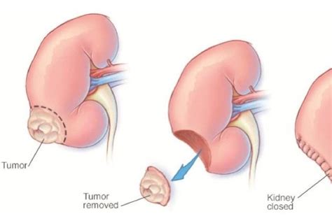 Robotic Partial Nephrectomy — ROBOTIC UROLOGY SANTA BARBARA - Dr Pierre ...