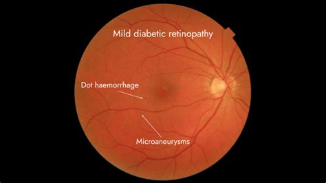 Stages and classification of diabetic retinopathy - EyesMatterMost