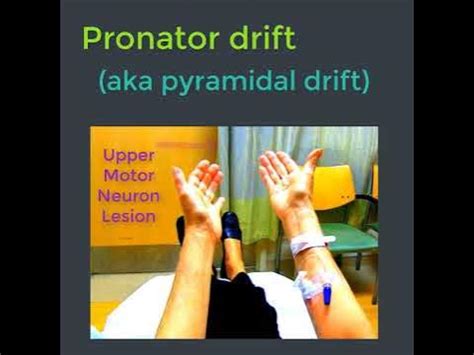 Pronator drift - YouTube