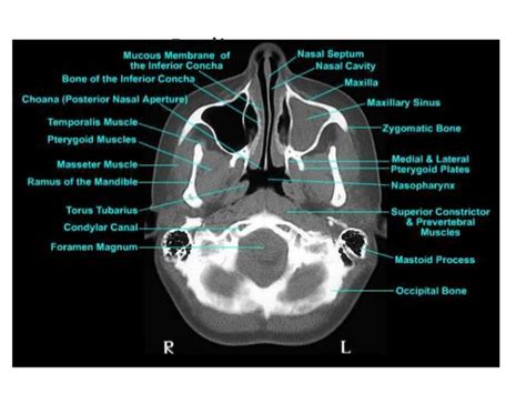 Radiologist For Ever: Parapharyngeal space rule 1:Anatomy and pathology