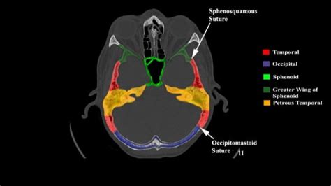 Temporal Bone Ct Anatomy - Anatomical Charts & Posters