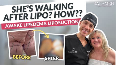 The Best Awake Lipedema Liposuction Result Ever! | Salameh Plastic Surgery Center | Dr. Salameh ...