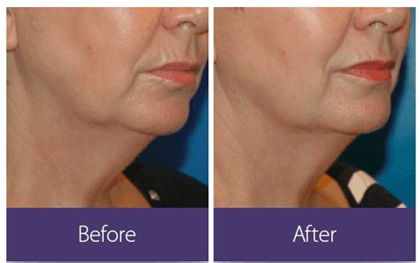 Laser Fat Removal | Walnut Creek, CA | Lavoro Laser